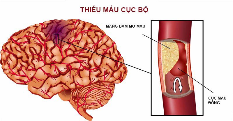 Cách điều trị tích cực đột quỵ não